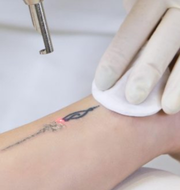 How Q Switch Laser Machines Remove Tattoos Fast?